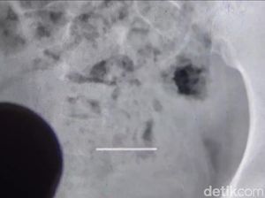 Jarum Pentul Tertelan, Remaja Sumedang Dilarikan ke RS