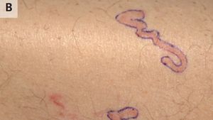 Merinding! Potret Tubuh Ruam Merah, Ternyata Ada Cacing Merayap di Bawah Kulit