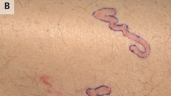 Merinding! Potret Tubuh Ruam Merah, Ternyata Ada Cacing Merayap di Bawah Kulit