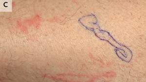 Ngeri! Ruam Kulit Pria Ini Bergerak, Ternyata Ada Cacing Merayap