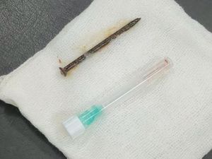 Pria di Riau Tersedak Paku Saat Perbaiki Kamar, Nyangkut di Paru-paru