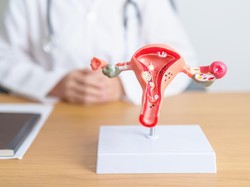 PCOS Berganti Nama Menjadi PMOS, Apa Bedanya? Ini Penjelasan Obgyn