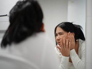 Diet Rendah Gula Bisa Atasi Jerawat? Ini Faktanya