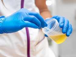 Waspadai Warna Urine Seperti Ini Jadi Tanda ISK, Bisa Fatal Jika Tak Ditangani