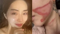 Niat Glow Up Berujung Pahit, Kwon Mina Alami Luka Bakar Saat Perawatan Kulit