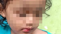 Fakta-fakta Balita di Surabaya Dianiaya Paman dan Bibi hingga Kepala Botak
