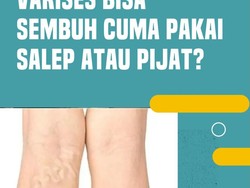 Video Benarkah Varises Bisa Sembuh dengan Salep atau Pijat?