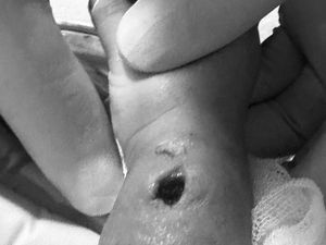 Tangan Bayi Berlubang Diduga Korban Malpraktik, RS di Makassar Buka Suara