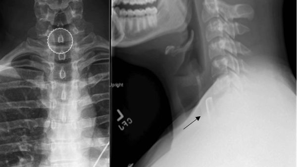 Ngilu! Penampakan Tutup Botol Nyangkut di Tenggorokan, Tak Sengaja Tertelan