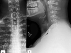 Ngilu! Pria Ini Tak Sengaja Telan Tutup Botol Besi hingga Nyangkut di Tenggorokan