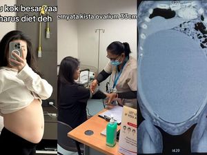 Awal Mula Wanita Surabaya Kena Kista Ovarium Sebesar 33 Cm, Perutnya Buncit