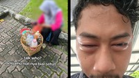 Viral Wajah Pria Bengkak Usai Minum Jamu Sachet, Ternyata Mengandung Ibuprofen
