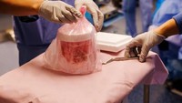 Rekor Terlama, Pria AS Hidup 271 Hari dengan Ginjal Babi sebelum Terima Donor Manusia