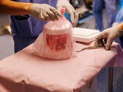 Rekor Terlama, Pria AS Hidup 271 Hari dengan Ginjal Babi sebelum Terima Donor Manusia