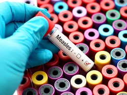 Kenali Gejala Campak, Dialami Selebgram Ruce Nuenda yang Viral Keluyuran saat Sakit