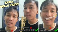 Viral Pria Idap Bell's Palsy, Bikin Mulutnya Miring ke Satu Sisi