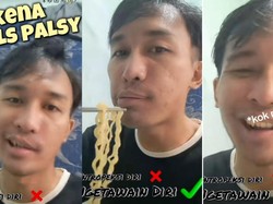 Viral Pria Idap Bells Palsy, Bikin Mulutnya Miring ke Satu Sisi