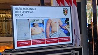 3 Dokter Spesialis Tangani Aktivis KontraS Disiram Air Keras, Mata Rusak Parah