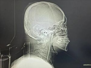 Ngeri! Sumpit Logam 12 Cm Tersangkut di Tenggorokan Pria Selama 8 Tahun