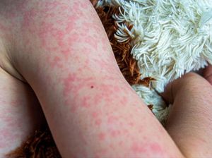 Kasus Campak pada Anak Meningkat, Dokter Ungkap Gejala-Cara Mencegahnya