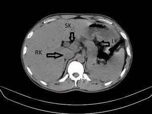 Ginjal Ketiga Pria di India Bentuknya Mirip Tapal Kuda