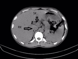 Penampakan Ginjal Ketiga pada Pria India, Bentuknya Mirip Tapal Kuda