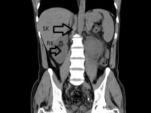 Pria 31 Tahun Niat Berobat gegara ISK Parah, Dokter Malah Temukan Ginjal Ketiga