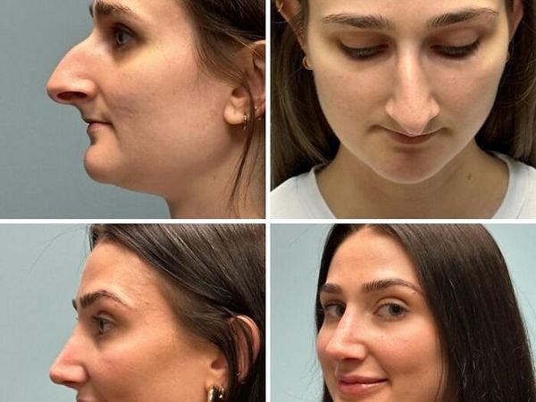 10 Before-After Operasi Plastik dengan Hasil Mengagumkan