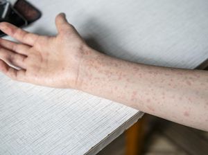 Selain Palembang, Kasus Campak di Banyuasin dan Musi Rawas Tercatat Tinggi