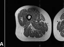 Potret Makanan UPF Bikin Paha Manusia Mirip Daging Berlemak, Seserius Ini Efeknya