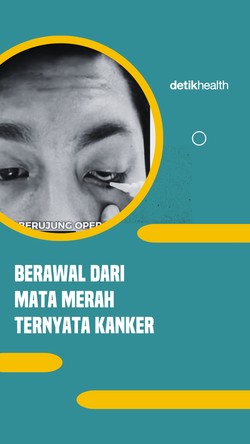 Video: Viral Pria Medan Kena Kanker, Bola Mata Harus Diangkat