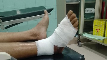 Pria di Brebes Digigit Ular Viper Saat Cari Rumput, Kaki Melepuh