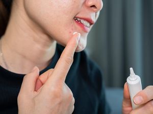 Benarkah Benzolac Ampuh Atasi Jerawat dan Bekasnya?