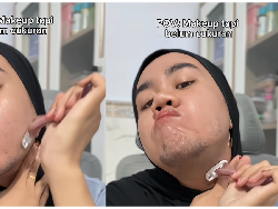 Viral Gadis 23 Tahun di Madura Tumbuh Brewok, Ternyata Idap Kondisi Ini