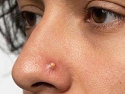 Pimple Piercing Jadi Tren Baru, Pasang Tindik Mirip Jerawat di Hidung