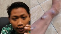 Viral Cerita Pria Tuban Cuci Darah di Usia 20-an, Begini Kondisinya Sekarang