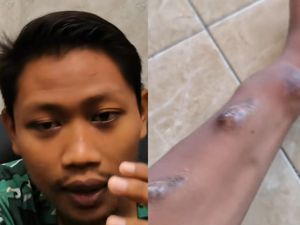 Viral Pria Tuban Idap Gagal Ginjal di Usia 20-an, Mengaku Keseringan Makan Mi Instan