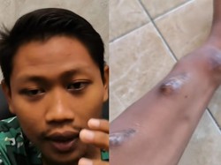 Viral Cerita Pria Tuban Cuci Darah di Usia 20-an, Begini Kondisinya Sekarang