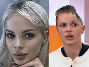Nasib Model yang Tengkoraknya Hancur Dipukuli Pacar, Jalani Pemulihan Panjang