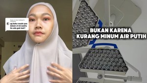 Dokter Beberkan Beda Wajah Khas Gagal Ginjal dengan Kondisi Biasa