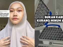 Viral Wanita Bekasi Disebut Dokter Punya Wajah Khas Gagal Ginjal, Apa Ciri-cirinya?