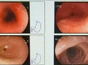 Gegara Makan Hotpot Panas, Kerongkongan Wanita Ini Luka Sepanjang 8 Cm