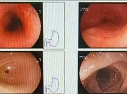Gegara Makan Hotpot Panas, Kerongkongan Wanita Ini Luka Sepanjang 8 Cm