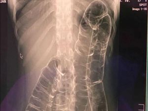 Viral Hasil Rontgen Usus Wanita Susah BAB, Penampakannya Bikin Merinding