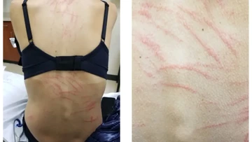 Makan Jamur Shiitake, Punggung Wanita Ini Dipenuhi Ruam Mirip Bekas Cambukan