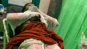 Siti Alami Luka Bakar 80 Persen Usai Dianiaya Mantan Suami Sirinya