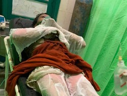 Siti Alami Luka Bakar 80 Persen Usai Dianiaya Mantan Suami Sirinya