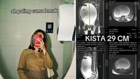 Viral Perut Wanita Bekasi Membesar Dikira Lemak, Ternyata Kista Ovarium 29 Cm