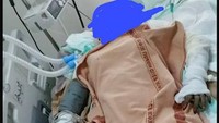 Siti yang Dibakar Mantan Suami Masih Kritis, Biaya Pengobatan Gratis