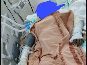 Siti yang Dibakar Mantan Suami Masih Kritis, Biaya Pengobatan Gratis